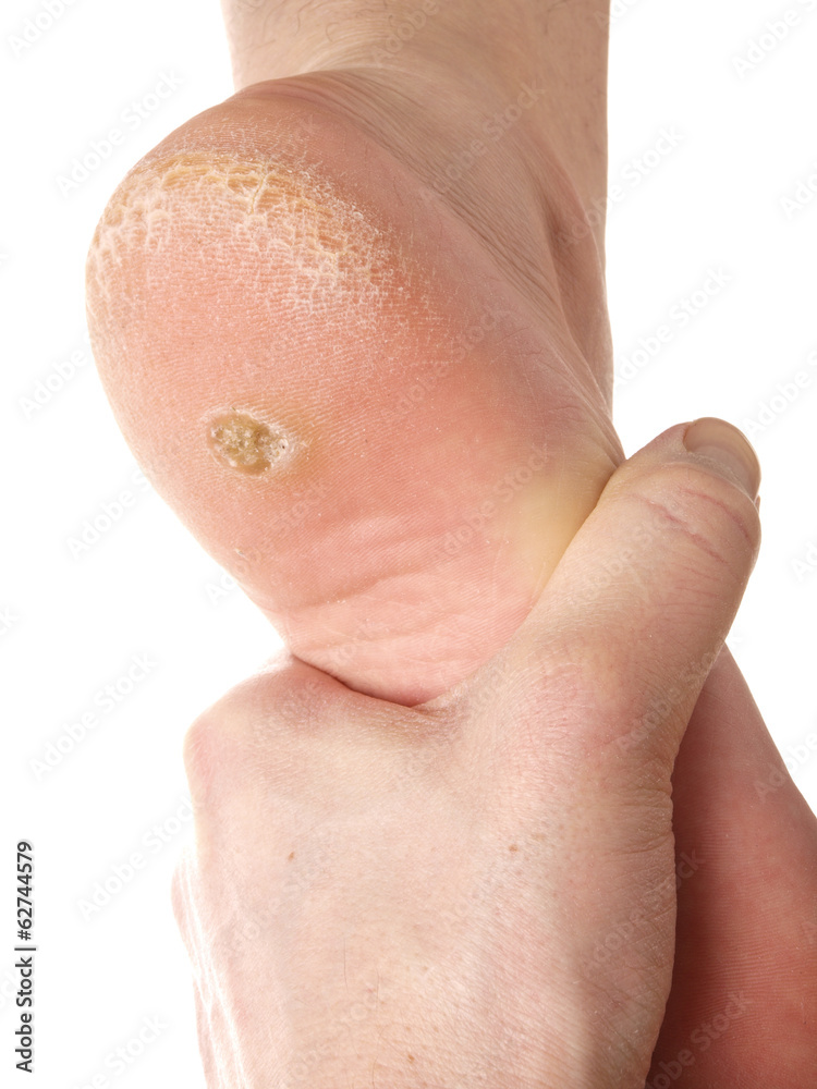 Fototapeta premium Dry skin under foot