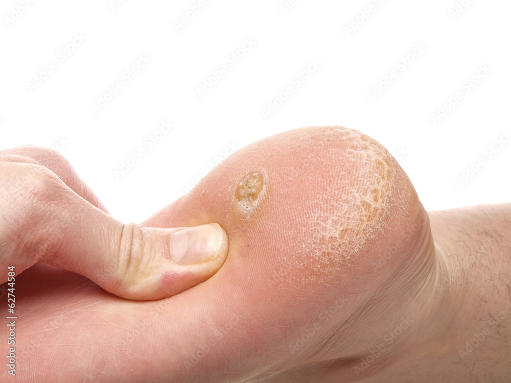Dry Skin Corn On Big Toe Hard Dry Skin On Toes Hard Dry Skin On Top