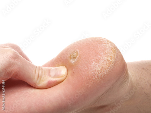 Dry skin under foot photo