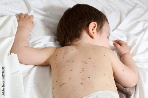 Chickenpox and baby