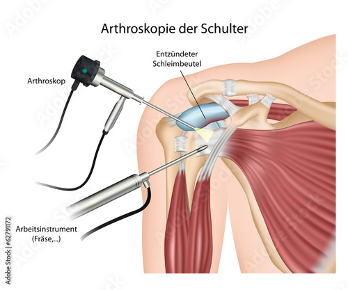 Arthroskopie der Schulter photo