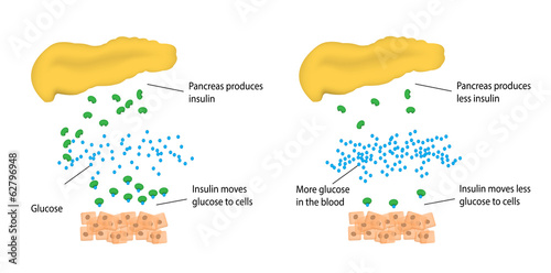 Type 2 Diabetes