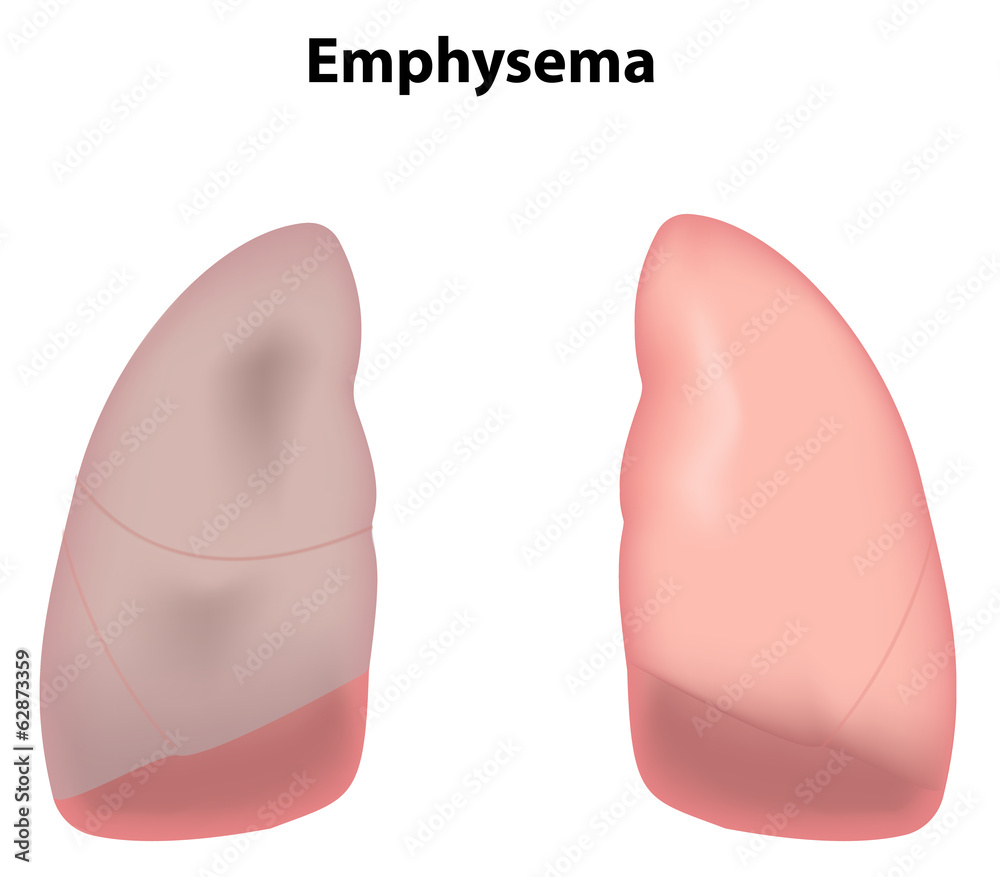 Emphysema Emphysema