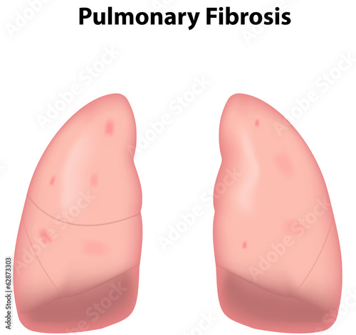 Pulmonary Fibrosis