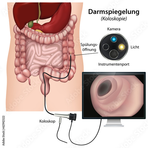 Darmspiegelung, Koloskopie Illustration