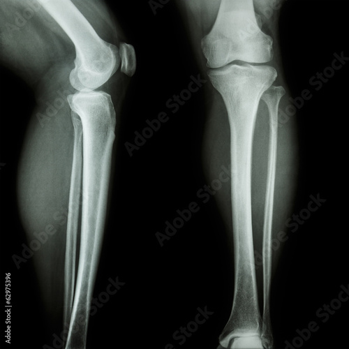 Radiographic Positioning of the Femur and Tib Fib CE4RT