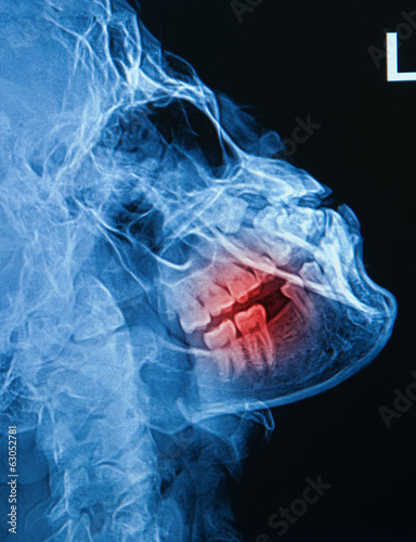 Fotografie x-ray image of human skull show fracture  mandible