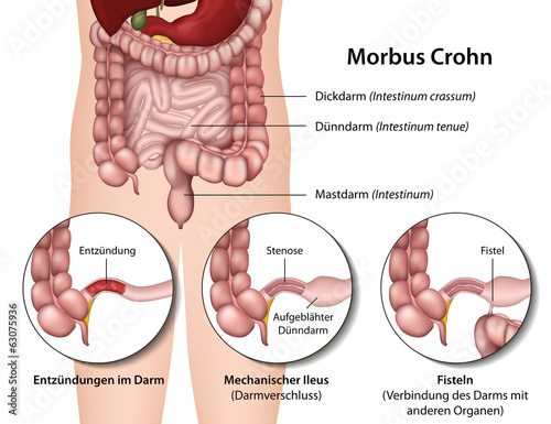 Morbus Crohn, Darmerkrankung Symptome photo