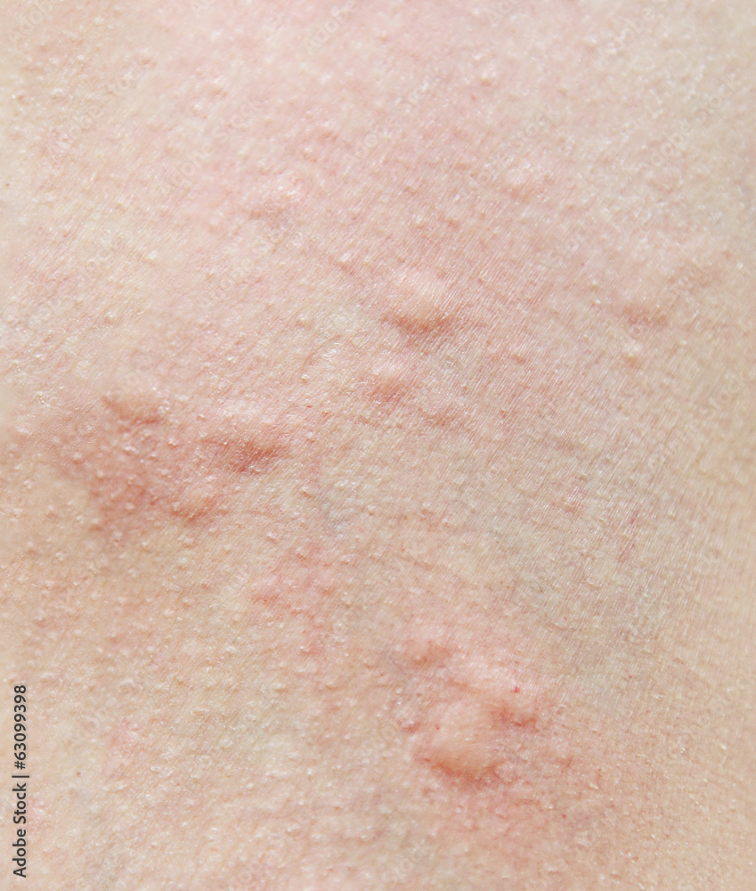 Human skin,with an allergic rash.