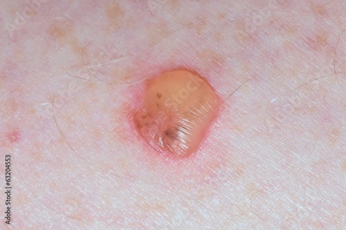 A blister wound on human caucasian skin photo