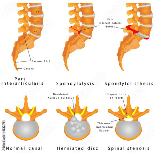 Spine Fracture. Spondylolysis (Spondylolisthesis) photo
