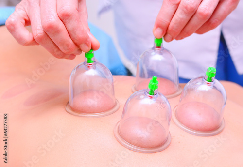 Cupping therapy, doctor removes cups from the patient's back