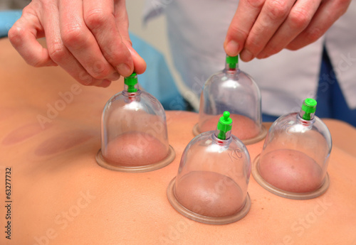 Cupping therapy, woman removes cups from the patient's back photo