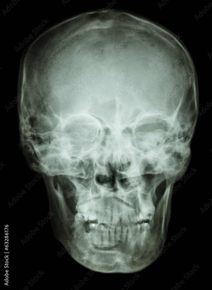 normal human skull normal human skull