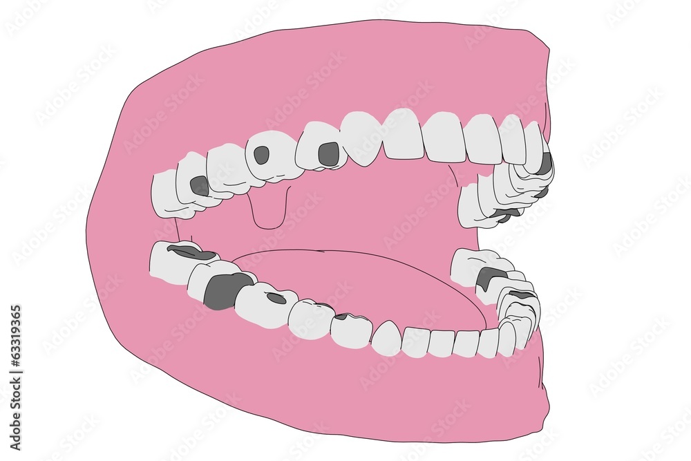 cartoon image of human teeth with fillings cartoon image of human teeth with fillings