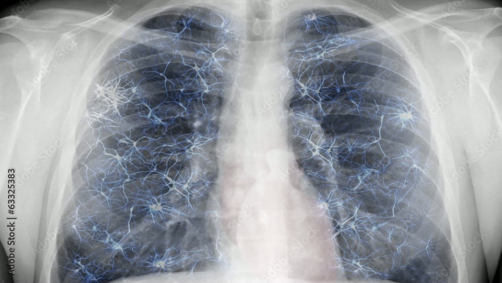 Chest x-ray - nervous system.