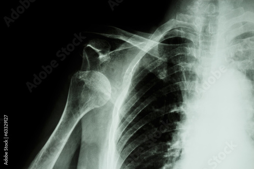 X-ray anterior shoulder dislocation photo