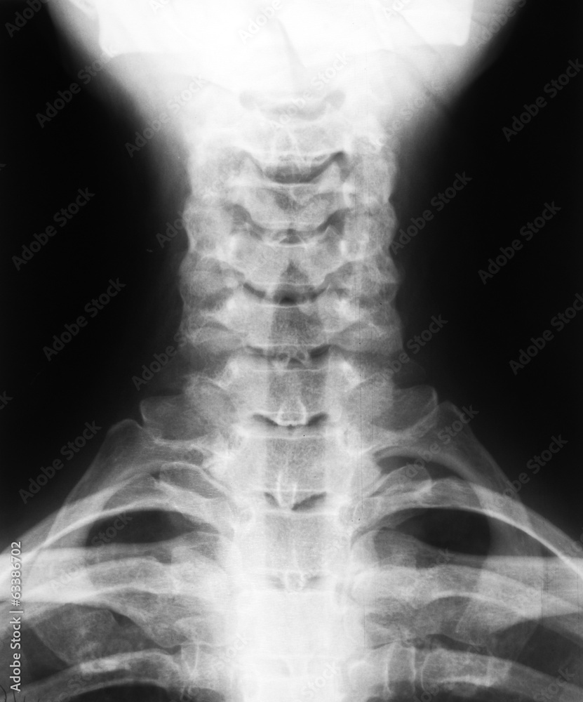 X-ray image of cervical vertebrae X-ray image of cervical vertebrae