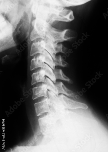 Wallpaper Mural X-ray image of spinal column.side view Torontodigital.ca