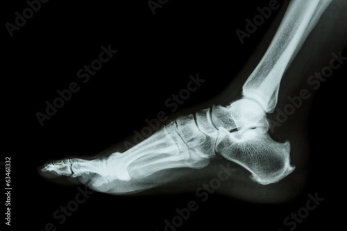 X-ray normal foot lateral