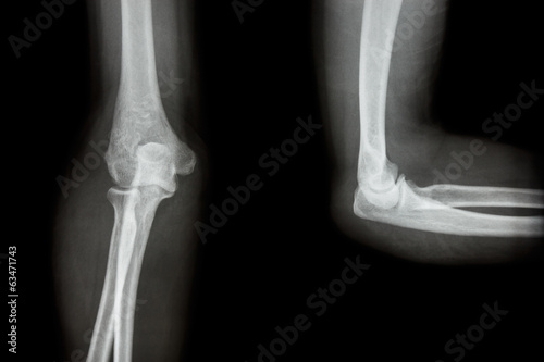 Canvas Print Film X-ray elbow AP(Antero-posterior)/lateral