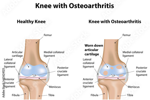 Knee Joint with Osteoarthritis Diagram