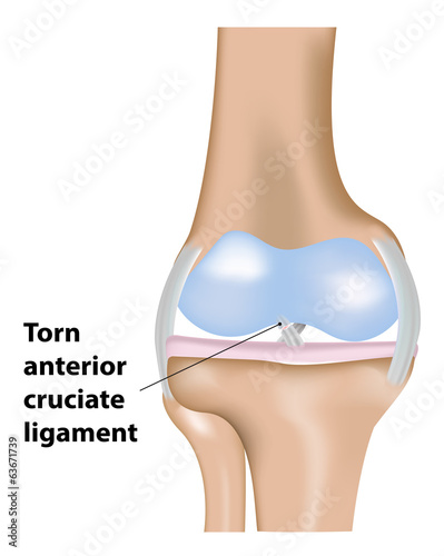 Torn ACL Ligament