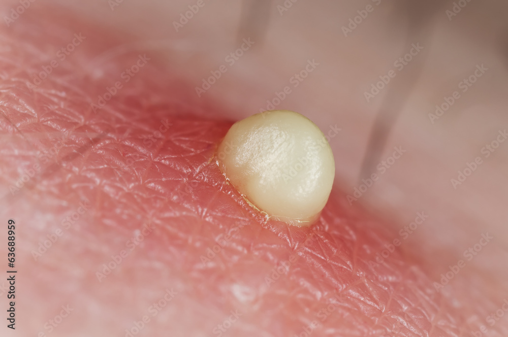 Fototapeta premium Zit ready to pop, extreme close-up