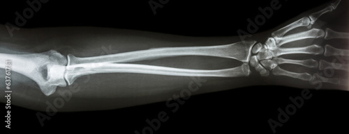 film x-ray forearm AP(antero-posterior)