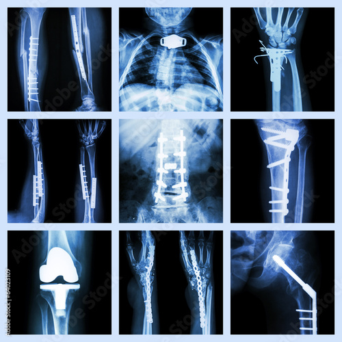 Collection of orthopedic operation