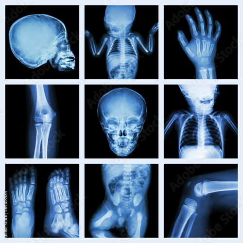 Collection x-ray part of child body