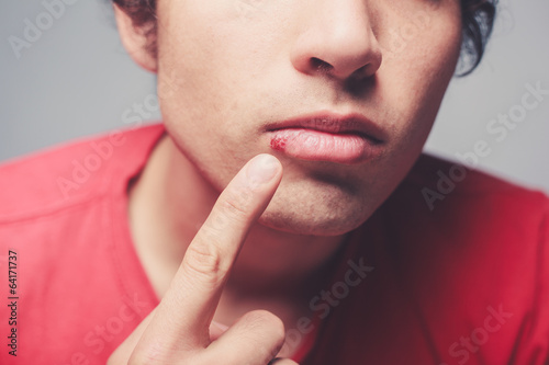 Young man with cold sore photo