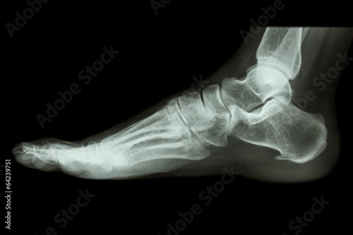 X-ray normal human's foot lateral