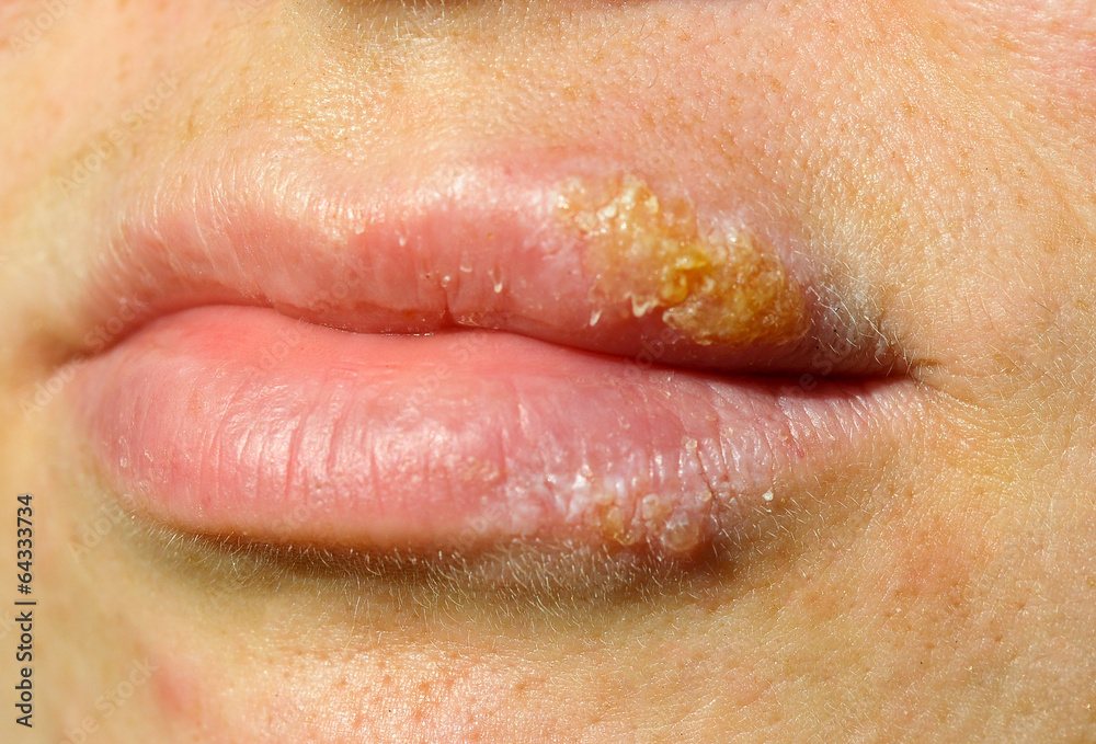 herpes herpes