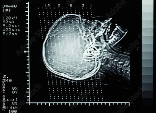 film CT scan (Computed tomography) brain : show section line on
