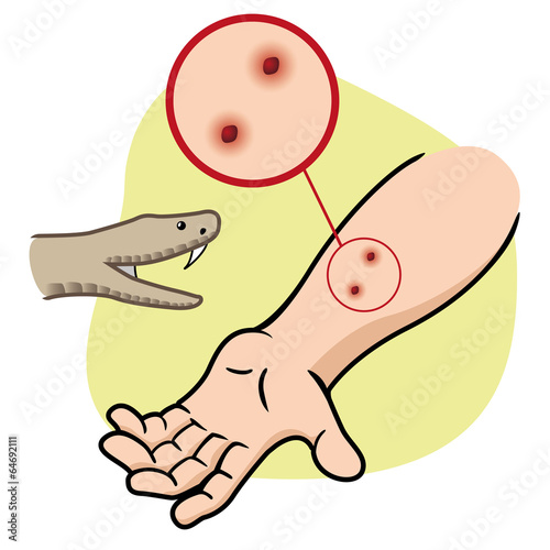 First Aid and snake bite on arm
