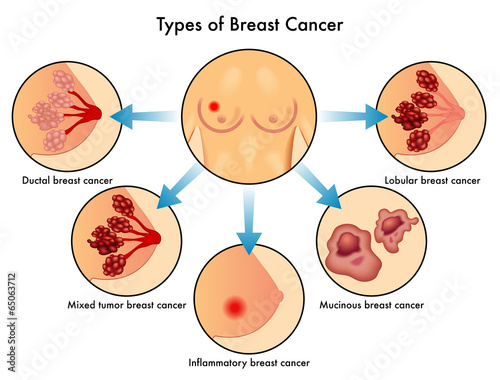 tipologie di cancro al seno