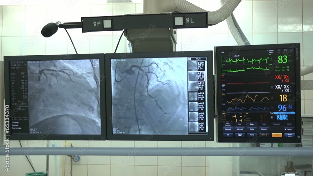 Heart Monitor ECG coronary angiography