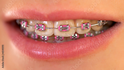 Pink braces