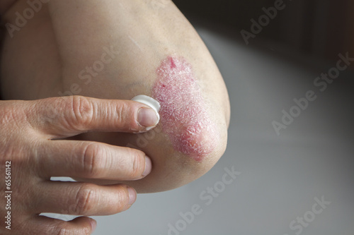 Psoriasis on elbow. Medical treatment photo