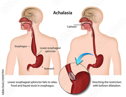 Achalasia medical vector illustration photo