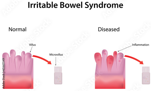 Irritable Bowel Syndrome