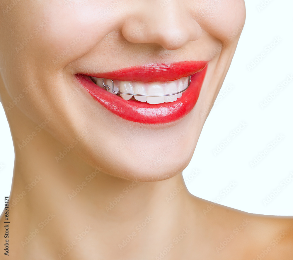 Beautiful smiling girl with retainer for teeth Beautiful smiling girl with retainer for teeth