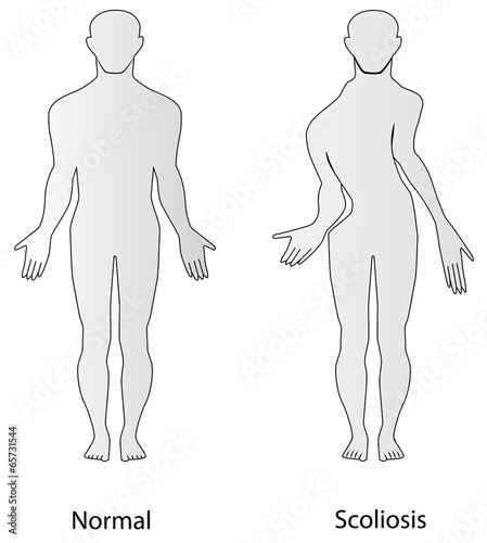 Scoliosis
