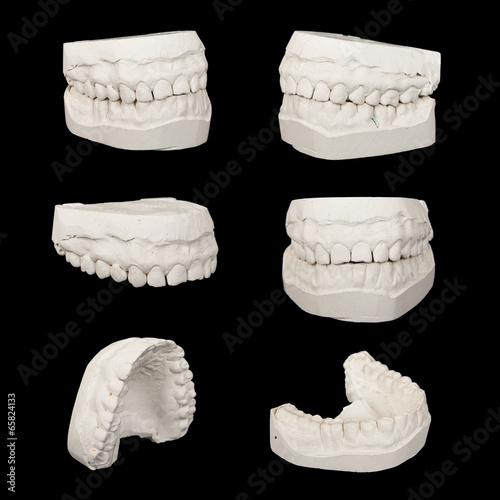 Set of Dental casting gypsum models plaster cast