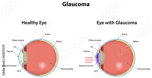 Glaucoma