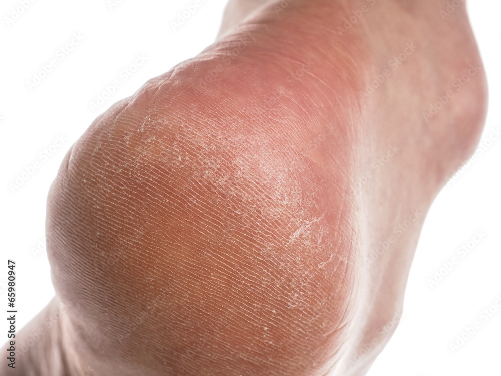 Fototapeta premium Dry skin on heel