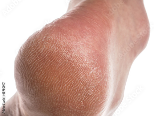 Dry skin on heel