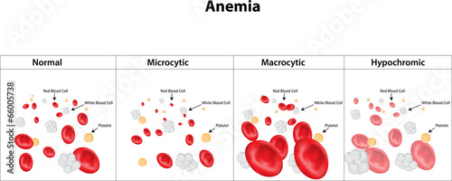Microcytic, Macrocytic and Hypochromic Anemia photo