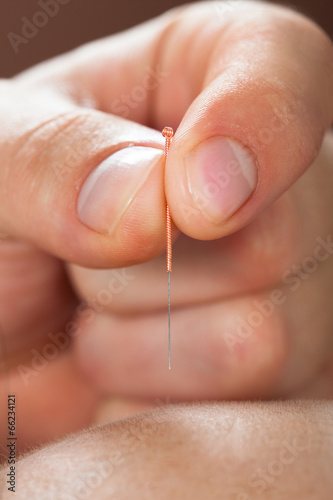 Woman Receiving Acupuncture Treatment At Spa